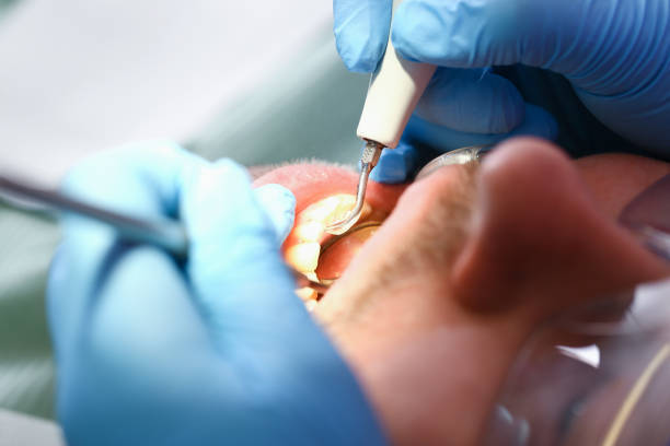 Best Emergency Dental Care for Broken or Chipped Teeth in Chesterbrook, PA
